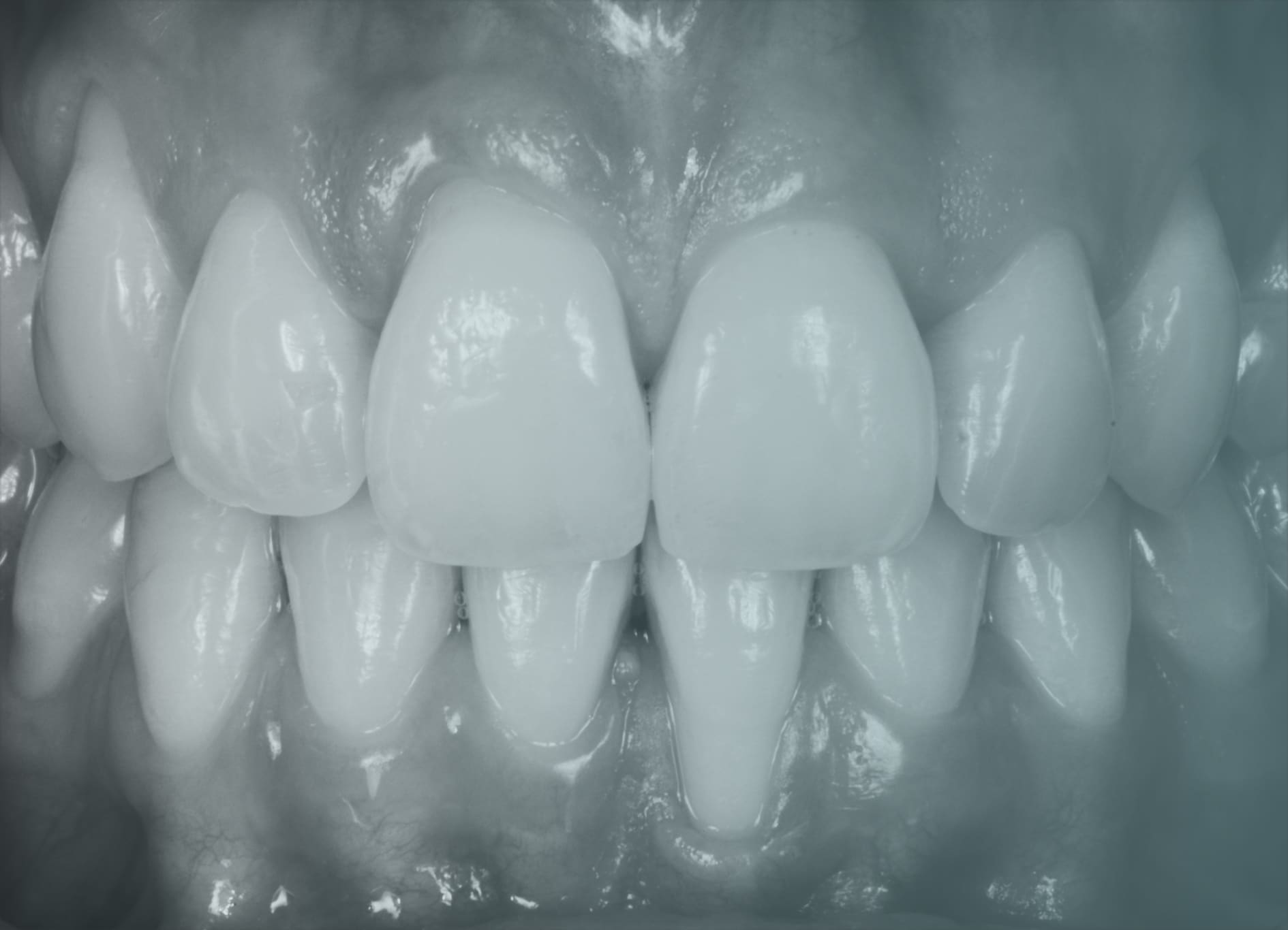 Récession gingivale | Rétraction des gencives | Cabinet dentaire | Dr Alexandre Sarfati | Paris 16