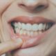Dans quel cas faut-il avoir recours à une greffe gingivale ?