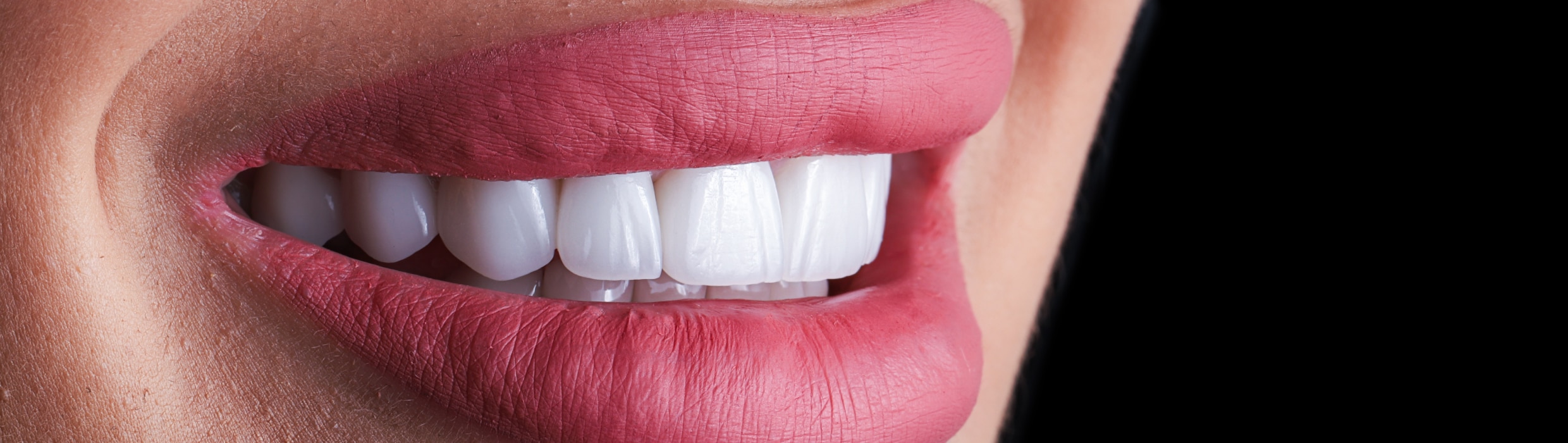 Facettes dentaires | Dr Alexandre Sarfati | Paris