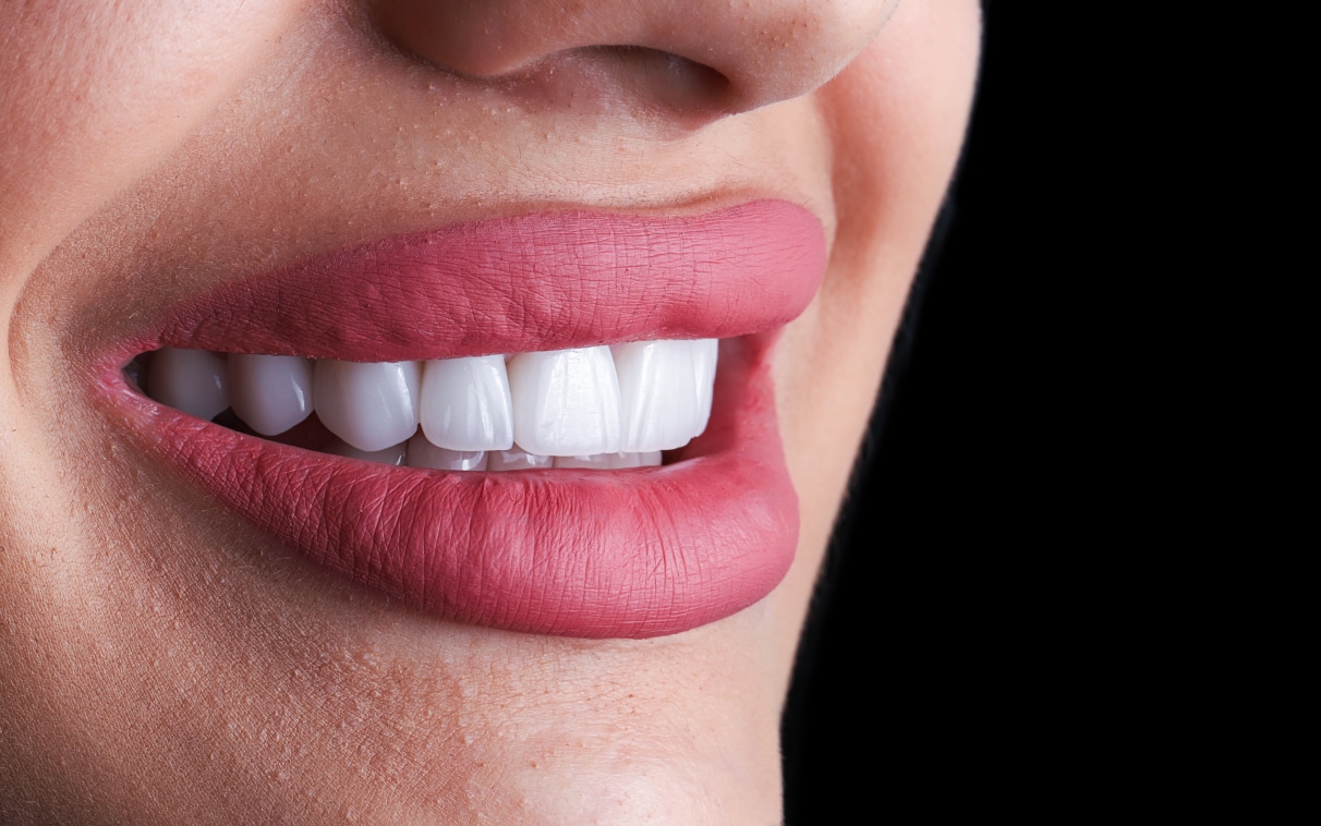 Facettes dentaires | Dr Alexandre Sarfati | Paris