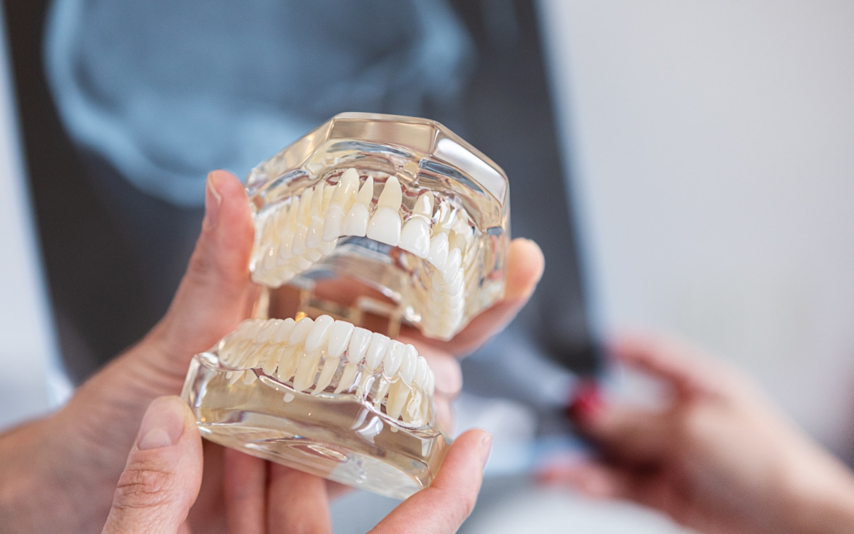 Récession gingivale | Dr Alexandre Sarfati | Paris