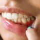 Récession gingivale et brossage trop agressif : que faire ?