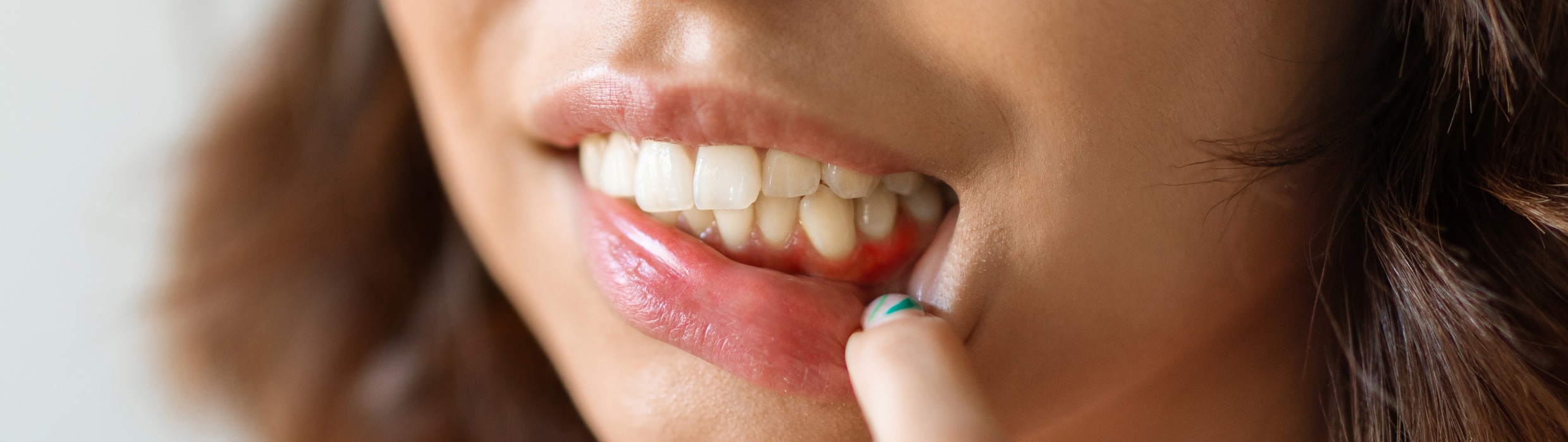 Récession gingivale | Dr Alexandre Sarfati | Paris