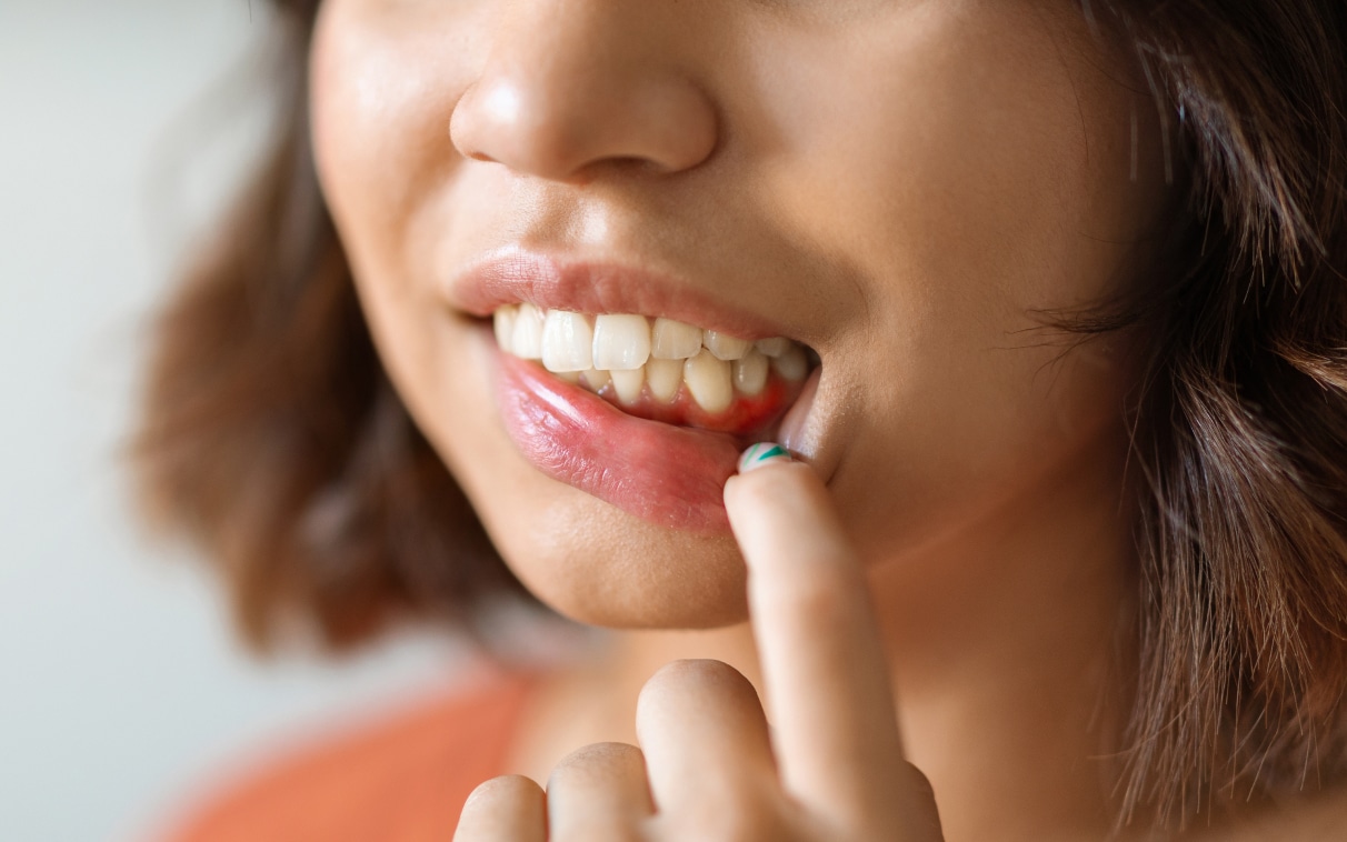 Récession gingivale | Dr Alexandre Sarfati | Paris