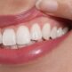 Récession gingivale : est-ce dangereux pour la dent ?