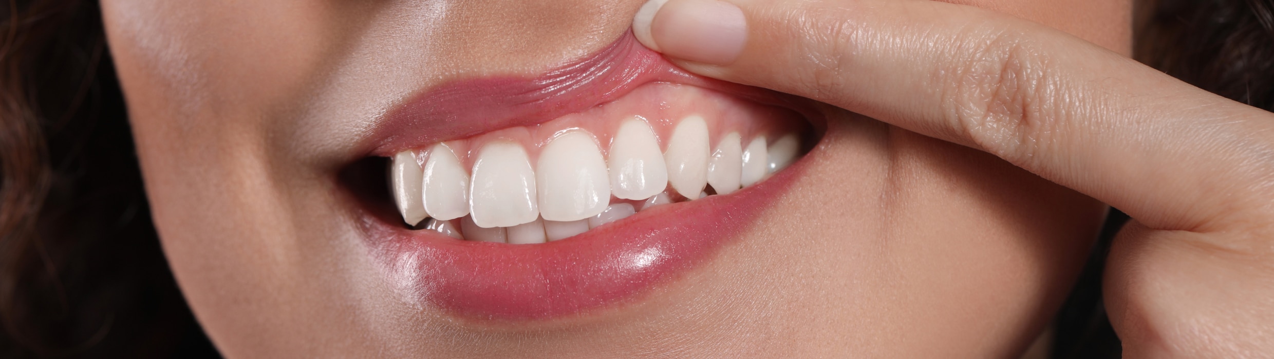 Récession gingivale | Dr Alexandre Sarfati | Paris