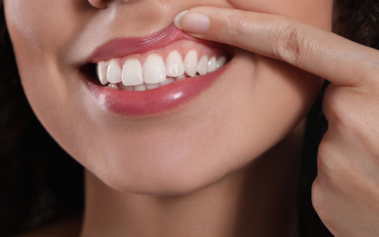 Récession gingivale | Dr Alexandre Sarfati | Paris